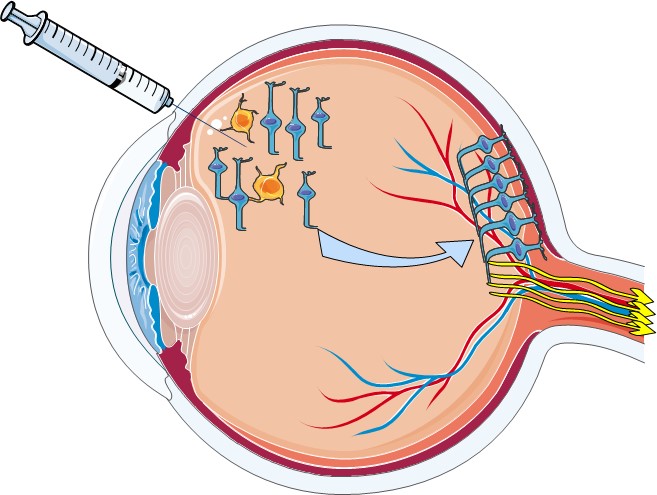 Cell Replacement in Optic Neuropathy