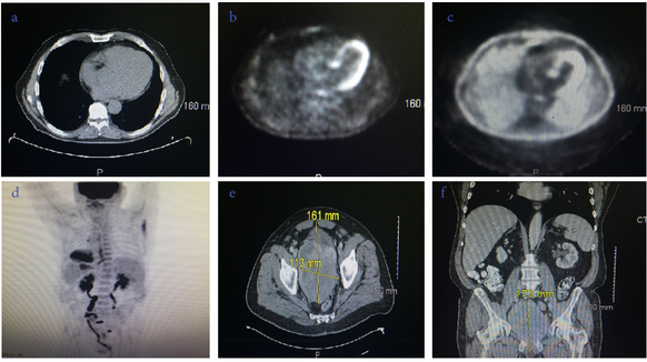 Figure 1: a.  Transverse CT without contrast showing lung mass in the left thoracic cavity. b.  Transverse PET scan without contrast showing lung mass in the left thoracic cavity.  c.  Transverse PET scan with contrast showing enhanced borders of the lung mass in the left thoracic cavity. d.  A/P PET scan results showing STAT 6 (+) Metastasis to the prostrate. e A/P, Tranverse, and Cranio-Caudal CT with dimensions of Solitary Fibrous Tumor of the Prostate.