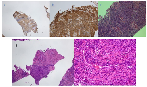 Figure 2: a) STAT 6 (-) Prostate tissue. b) CD 34 (+) Prostate tissue. c) Stat 6 (+) Lung tissue. d) Alternating hypo-cellular and hyper-cellular areas of malignancy with demarcated border e) Hyper-cellular areas with patch-less population of ovoid cells and spindle formations