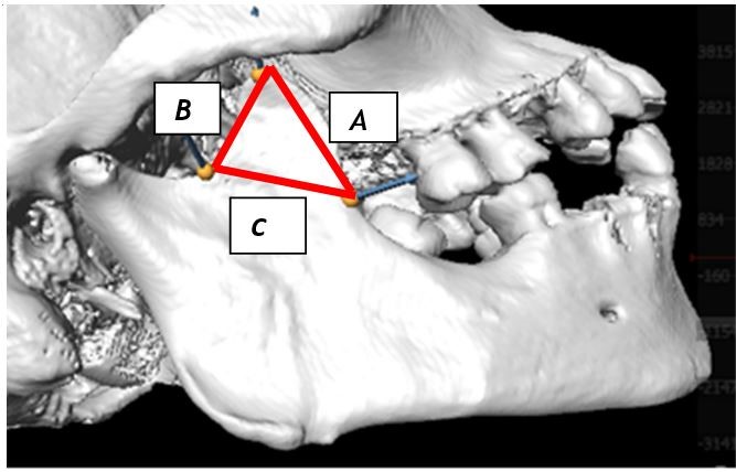 Figure 3: The border lines (A-C) formed on the right coronoid process.