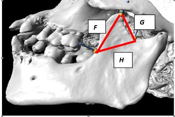 Figure 4: The border lines (F-H) formed on the left coronoid process.