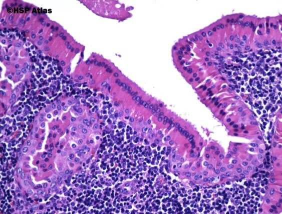 Warthins tumour with uniform epithelium overlying lymphoid follicles [18].