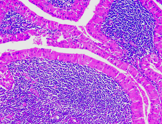  Warthin's tumour with oncocytic epithelium and lymphoid follicles [19].