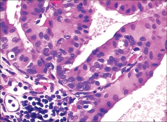 High grade adenocarcinoma in Warthin's tumour [20].