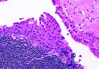 Squamous metaplasia in Warthin's tumour [25].