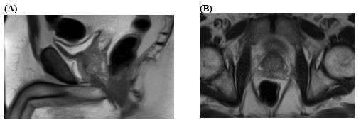 Figure 1: Magnetic resonance images of prostate pre-SpaceOAR placement.  (A) Sagittal image, (B) Axial image. 