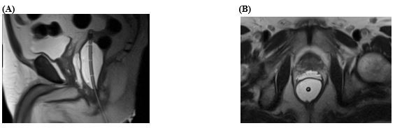 Figure 2: Magnetic resonance images of spacer post-application.  (A) Sagittal image, (B) Axial image. 