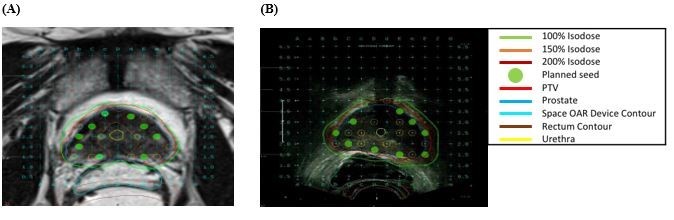 Figure 3: (A) Axial magnetic resonance image of pre-LDR brachytherapy plan, (B) Axial image of ultrasound intra-op plan