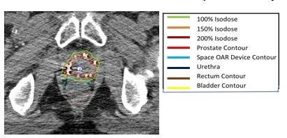 Figure 4: CT axial image of post-op plan