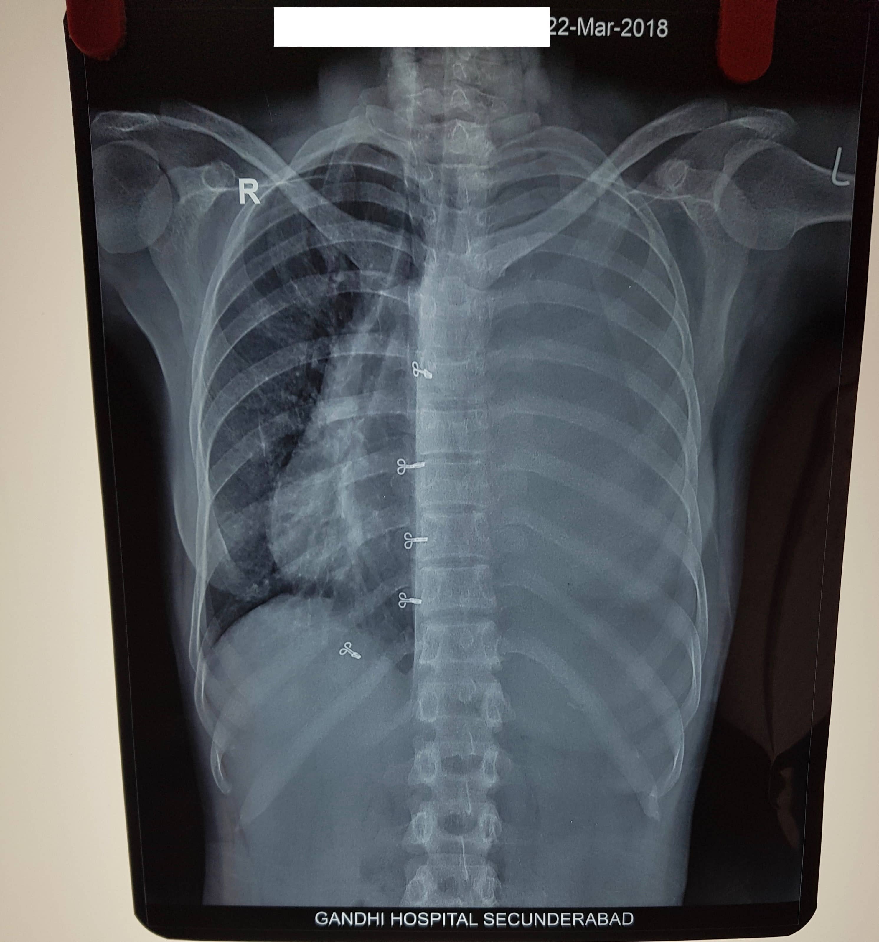 Figure 1: Chest X-ray showing massive left pleural effusion with mediastinal shift to right
