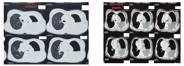 Figure 2, 3: CT scan chest showing left sided hydropneumothorax with collapsed left lung and doubtful mass within the collapsed lung (Lung window and mediastinal window).