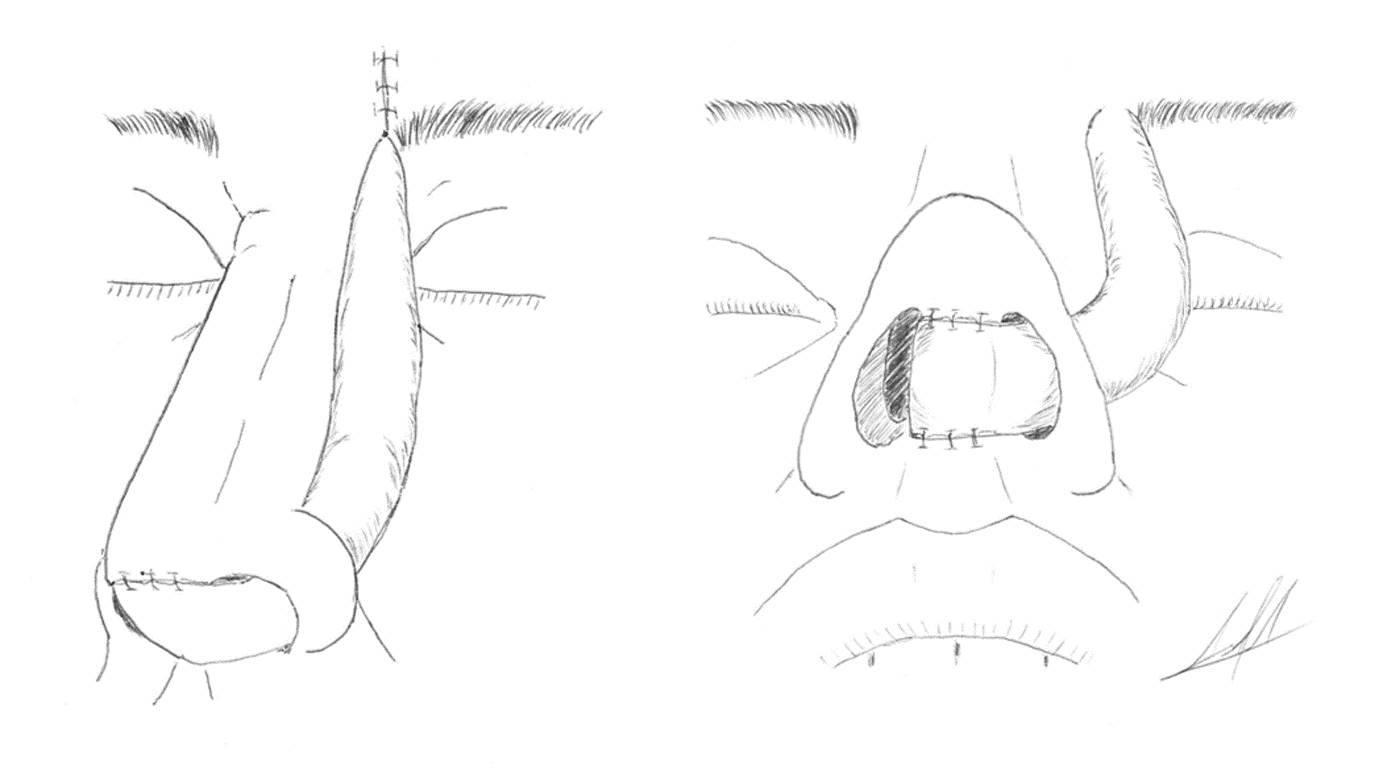 The forehead flap is passed through an incision in the alar-facial groove to reach the columella