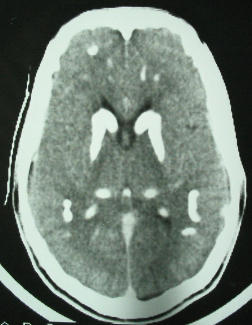 Figure 1: CT-scan in axial section, parenchymatous window: multiple bilateral and symmetrical calcifications of basal ganglia.