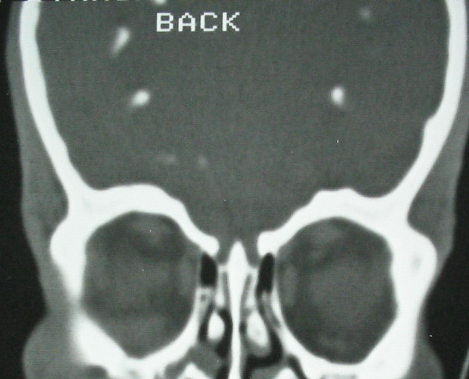 Figure 2: Brain CT in coronal reconstruction, bone window: multiple bilateral and symmetrical calcifications of basal ganglia.