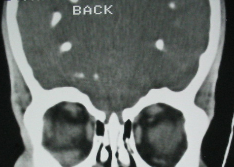Figure 3: CT brain in coronal reconstitution, parenchymatous window: multiple calcifications bilateral and symmetrical of the central gray nuclei.